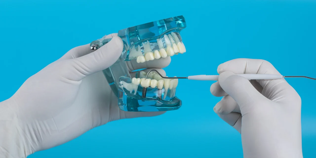 All-on-4 tandheelkundige implantaten