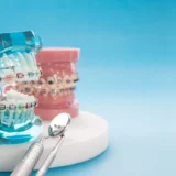 dedrietand invisalign