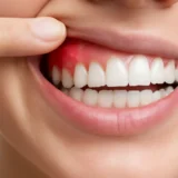 Tandvleesontsteking: Oorzaken en Oplossingen