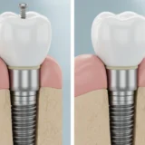 Schroefimplantaat of gecementeerd implantaat: welke keuze?