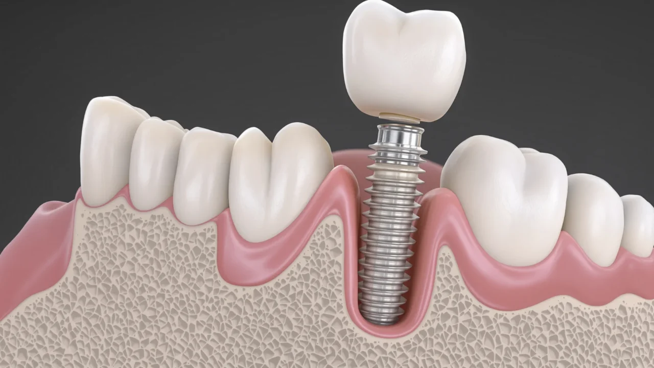 Mislukt tandimplantaat: symptomen en oorzaken