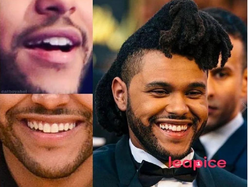 Welke beroemdheden hebben een tandheelkundige fineer?