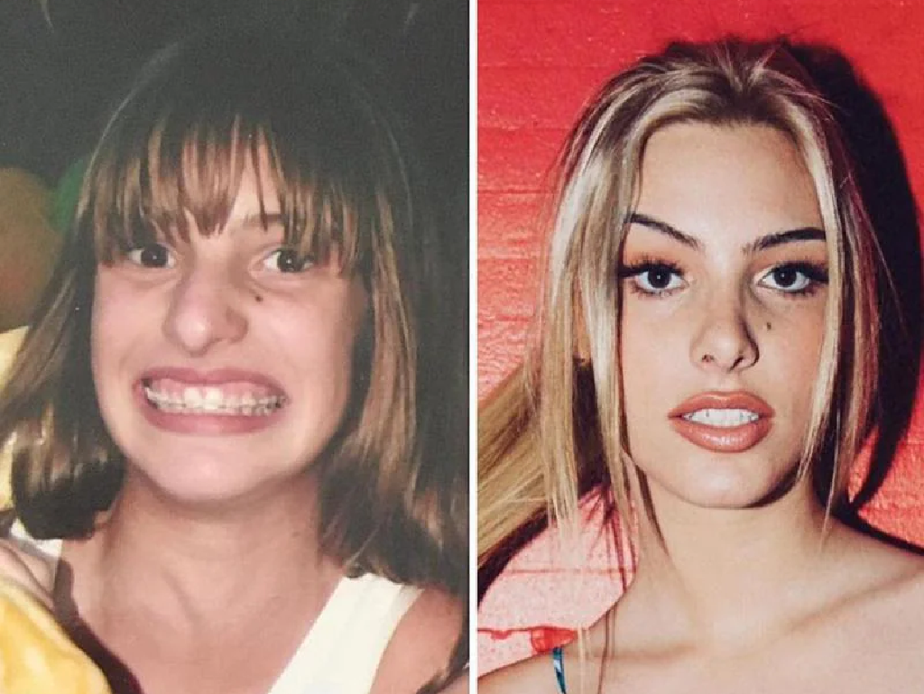 Welke beroemdheden hebben een tandheelkundige fineer?