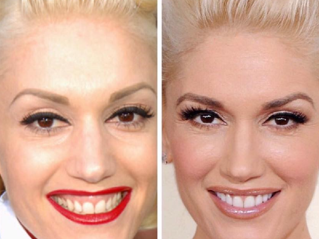 Welke beroemdheden hebben een tandheelkundige fineer?