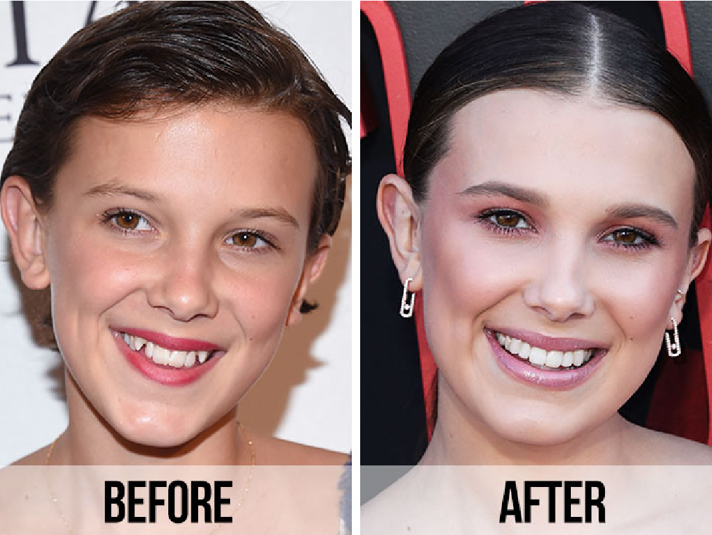 Welke beroemdheden hebben een tandheelkundige fineer?