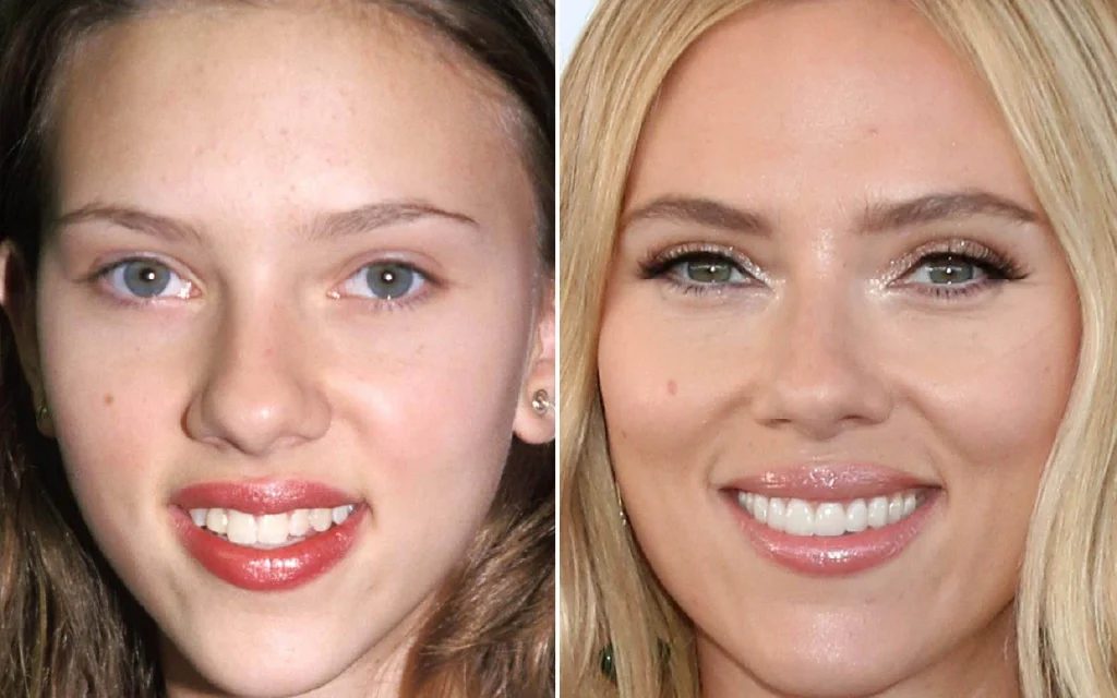 Welke beroemdheden hebben een tandheelkundige fineer?